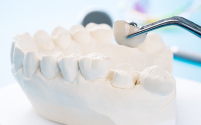 Benefits of Dental Crowns and Bridges