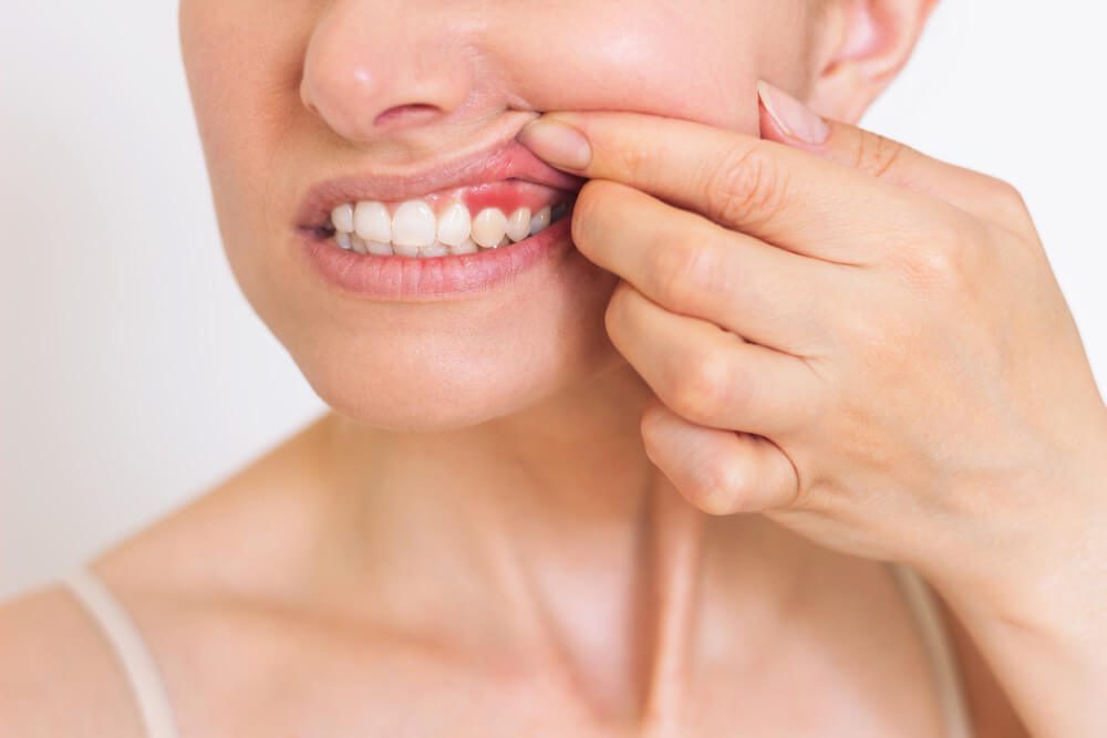 gingivitis causes symptoms prevention and treatment