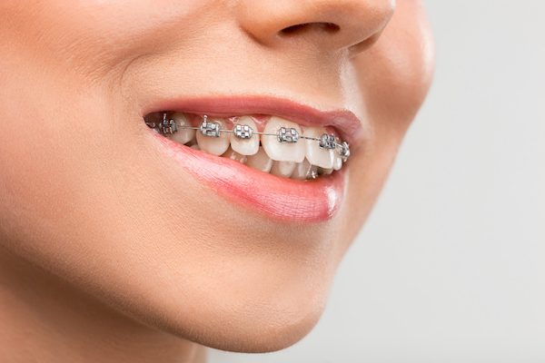orthodontic seven hills