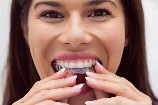 why choose clear aligners seven hills