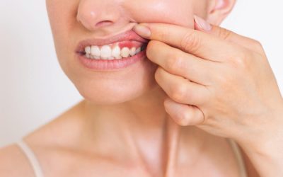 Gingivitis: Causes, Symptoms, Prevention, and Treatment