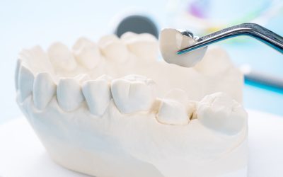 Benefits of Dental Crowns and Bridges